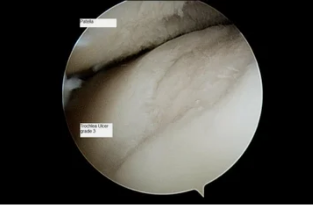 view astroscope on the knee with osteoarthritis grade 3