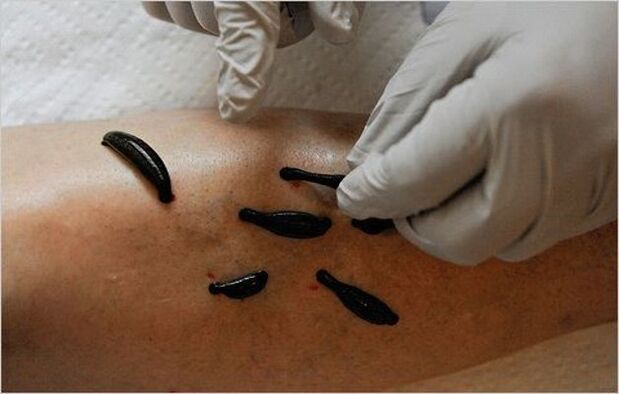 Leech for knee joint disease