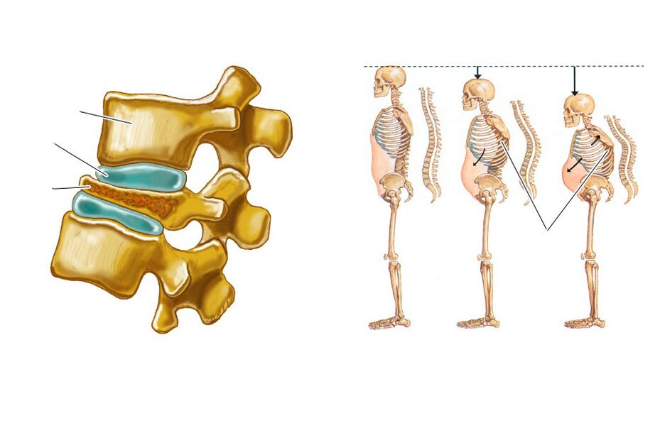 A drooping spine can cause back pain