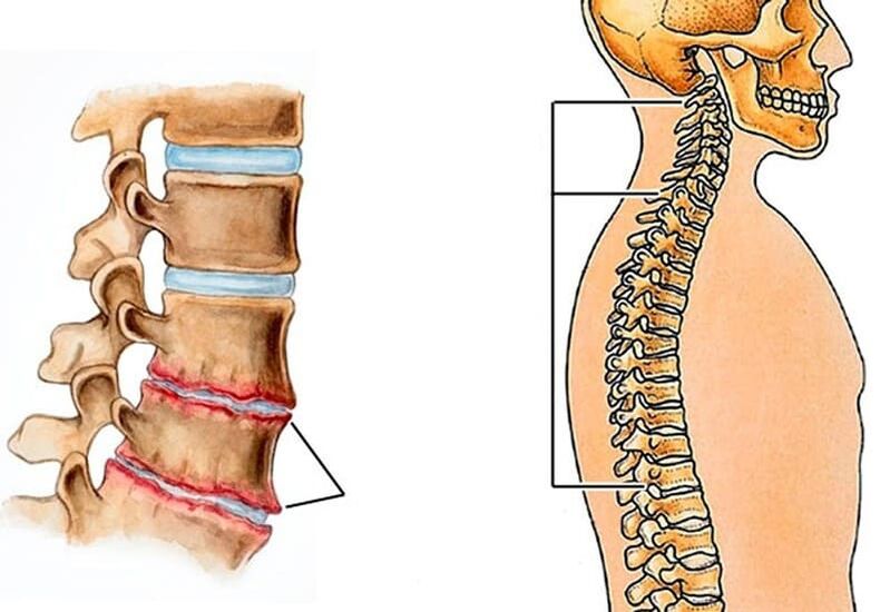 Curvature of the spine causes back pain