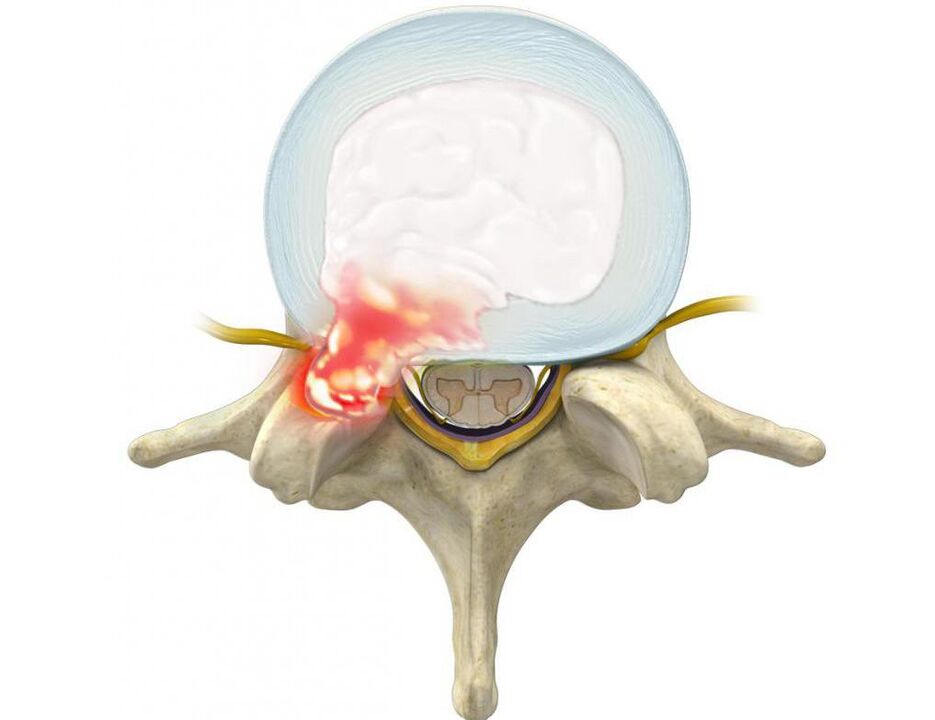 Damaged intervertebral discs cause back pain