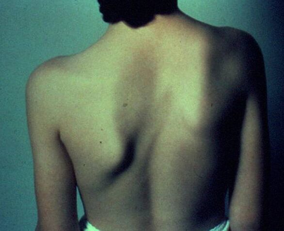 Sprengel's disease is the cause of pain under the left shoulder blade