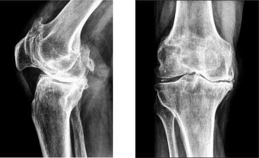 Knee joint disease on x-ray