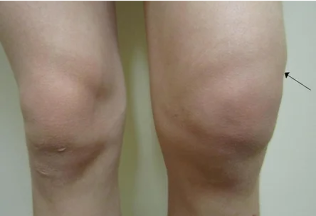 Hemarthrosis of the knee