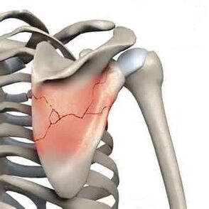 Fractures of the scapula are one cause of severe pain