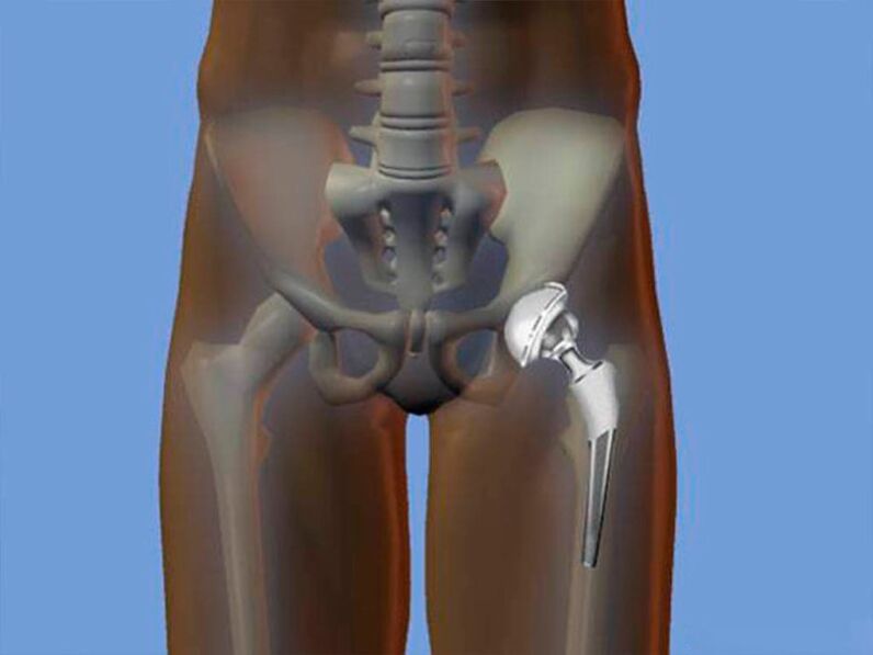 Hip replacement for pain