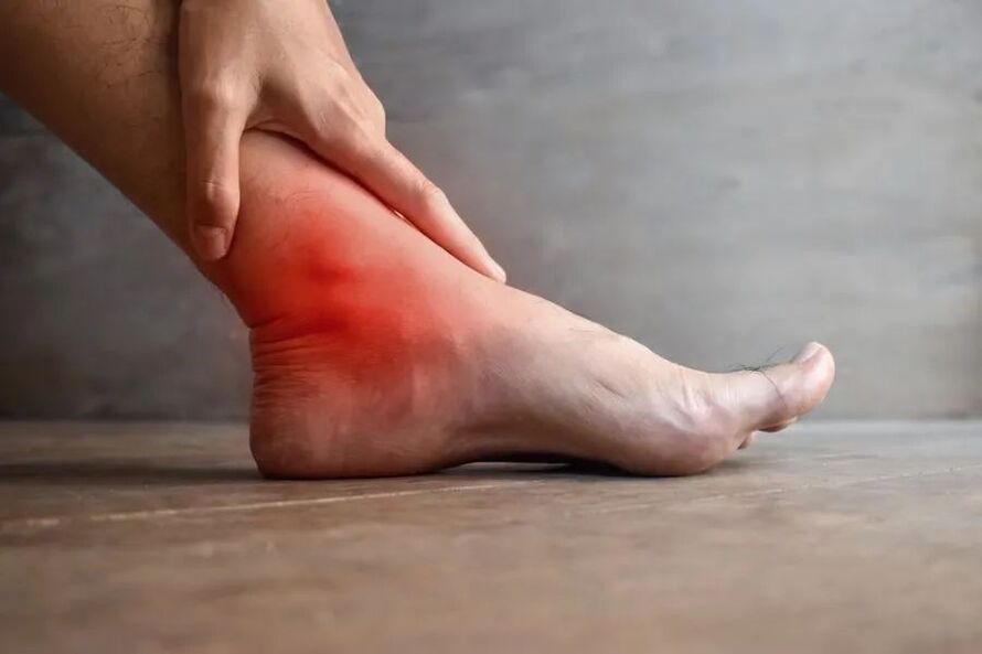 Ankle arthropathy