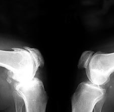 Osteoarthritis on x-ray.