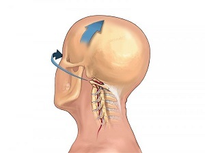 How does cervical osteochondrosis manifest