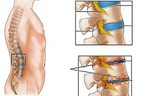 Causes of lumbar osteochondrosis