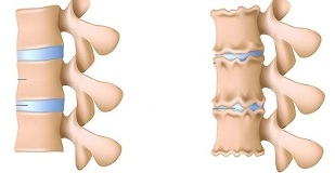 How to recognize the presence of lumbar osteochondrosis