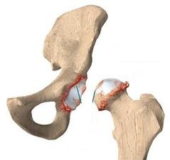 Causes of hip arthritis