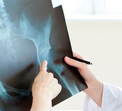 How to treat hip arthritis