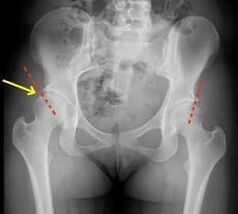 Treatment of hip arthritis