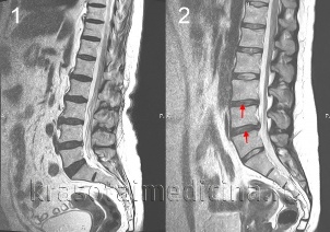 osteochondrosis of the vertebral column