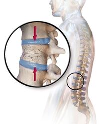 Osteoporosis causes low back pain