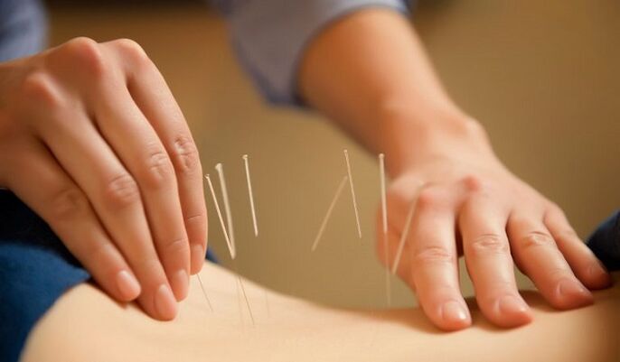 Acupuncture for low back pain