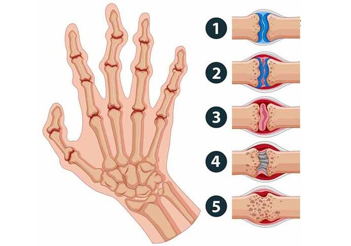 Stages of development of finger joint arthritis