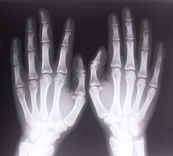 X-ray as a method of diagnosing finger joint pain